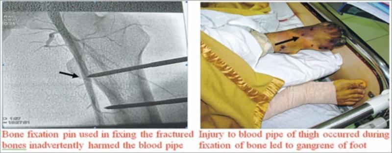  Bone fixation pin used in fixing the fractured bones inadvertently harmed the blood pipe ; Injury to blood pipe of thigh occurred during  fixation of bone led to gangrene of foo 